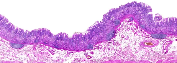 Chronische gastritis van een mens Rechtenvrije Stockfoto's