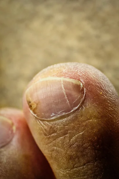 Toe nail macro with some cracks and damages needs some grooming. — Stock Photo, Image