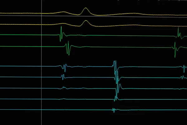 Heart cardiodiagram tracing — Stock Photo, Image