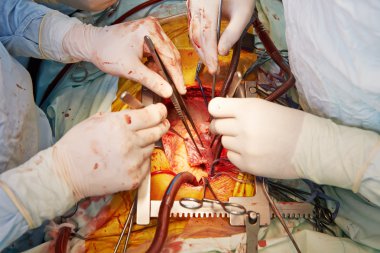 surgeons hands at cardiac surgery operation clipart