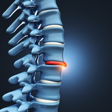 Fıtıklaşmış disk insan spinal