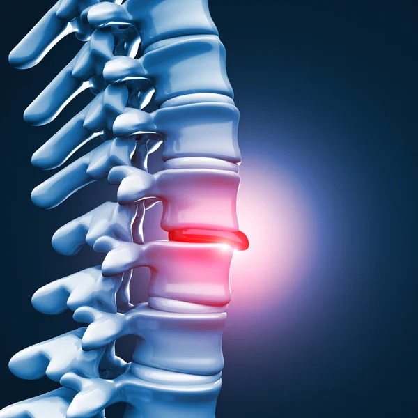 Fıtıklaşmış disk insan spinal