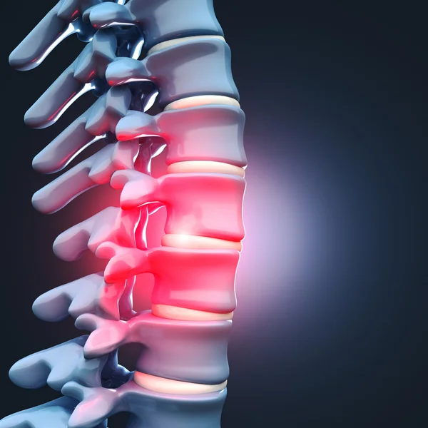 Ernia del disco spinale umana — Foto Stock