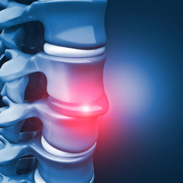 Diskbråck mänskliga spinal — Stockfoto