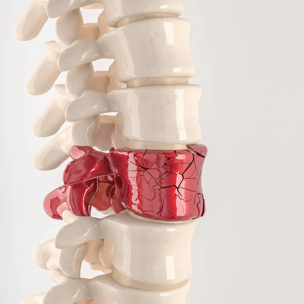 Spine Shattered Vertebrae Concept Physical Discomfort Render — Foto de Stock