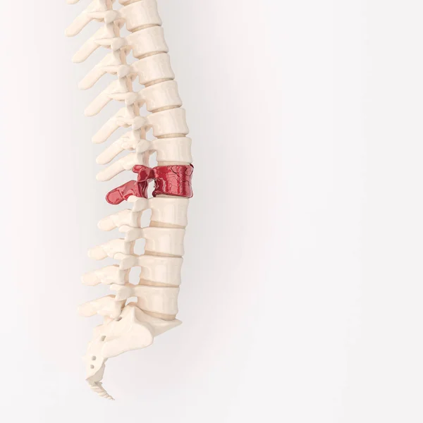 Wirbelsäule Mit Roten Gebrochenen Wirbeln Rückenprobleme Darstellung — Stockfoto