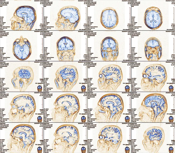 Risonanza magnetica imaging del cervello — Foto Stock