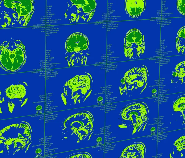 Magnetic resonance imaging of the brain — Stock Photo, Image