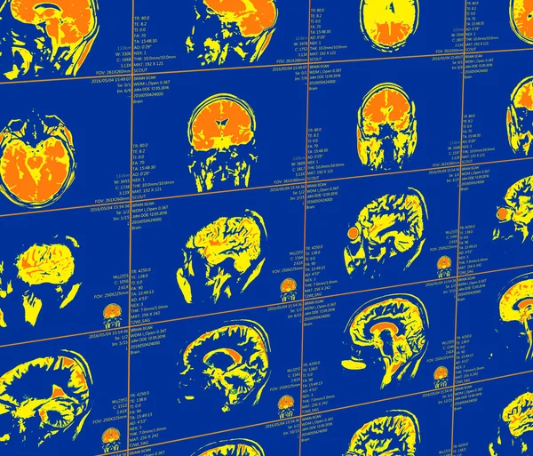 Magnetická rezonance mozku — Stock fotografie