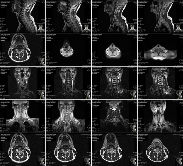 Ressonância magnética da coluna cervical . — Fotografia de Stock