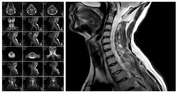 Ressonância magnética da coluna cervical . — Fotografia de Stock