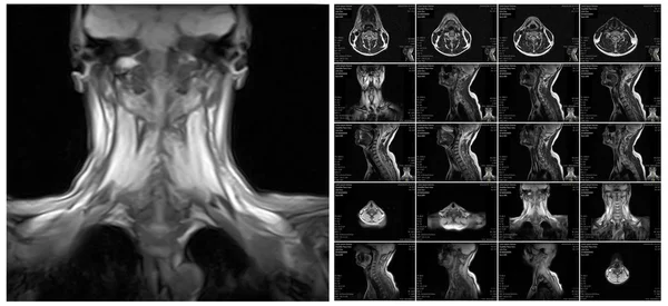 Ressonância magnética da coluna cervical . — Fotografia de Stock