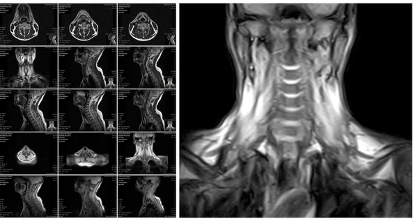 Магнитно-резонансная томография шейного отдела позвоночника . — стоковое фото