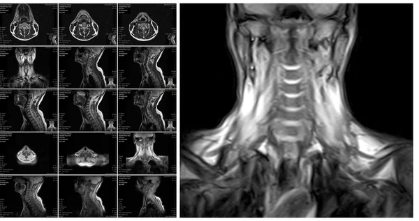 Ressonância magnética da coluna cervical . — Fotografia de Stock