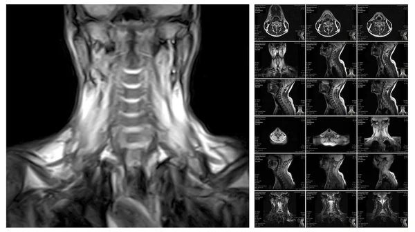 Ressonância magnética da coluna cervical . — Fotografia de Stock