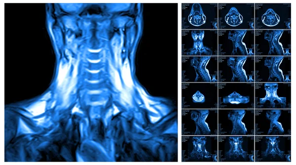 Ressonância magnética da coluna cervical . — Fotografia de Stock