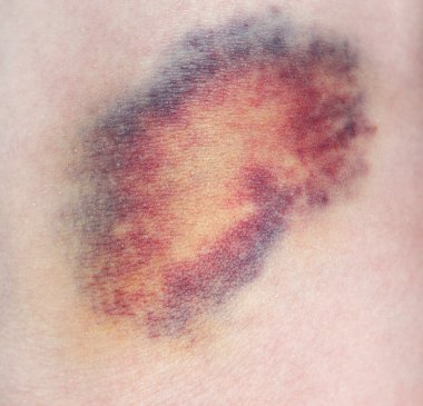 Bruise. Close-up photo clipart