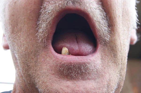Boca sem dentes — Fotografia de Stock