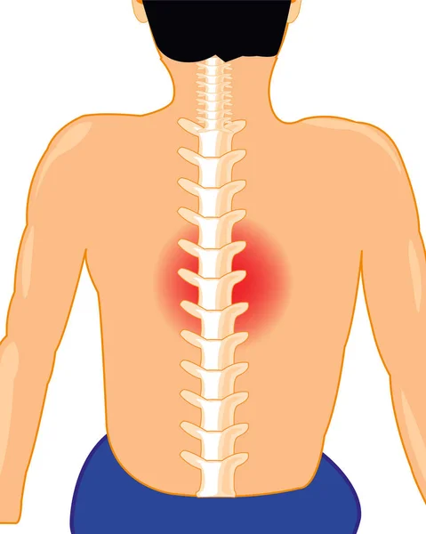 Hombre con columna vertebral enferma sobre fondo blanco está aislado — Archivo Imágenes Vectoriales