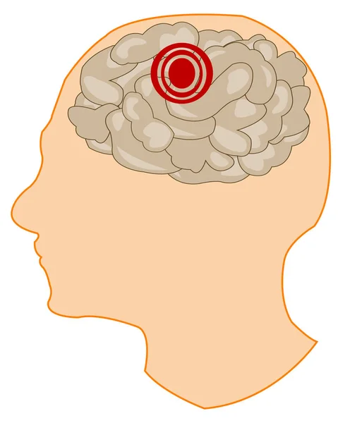 Cabeza de la persona con el cerebro enfermo — Vector de stock