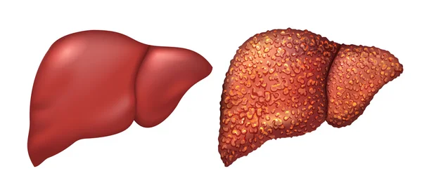 A máj az egészséges ember. Máj betegek hepatitis. Máj az beteg. Cirrhosis a máj. Befolyásolná az alkoholizmus — Stock Vector