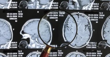 Beyin taraması arka plan, manyetik rezonans tomografisi. Doktor büyüteçle hastanın görüntülerini inceliyor..