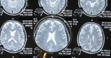 Beyin taraması arka plan, manyetik rezonans tomografisi. Doktor büyüteçle hastanın görüntülerini inceliyor..