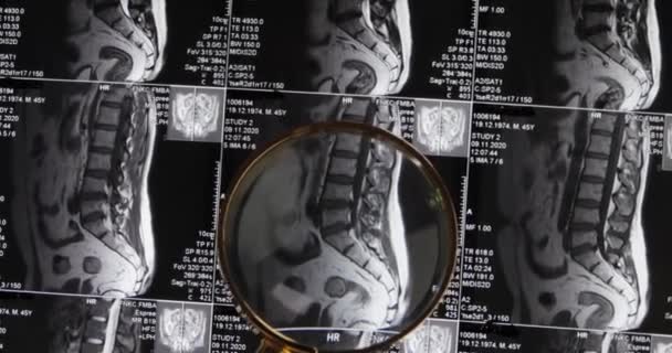 Mri Lumbale Wervelkolom Achtergrond Magnetische Resonantie Tomografie Doctor Onderzoekt Mri — Stockvideo