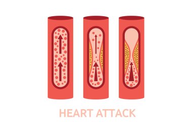 heart attack symptoms vector clipart