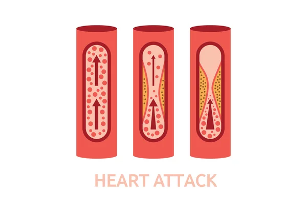 심장 마비 증상 벡터 — 스톡 벡터