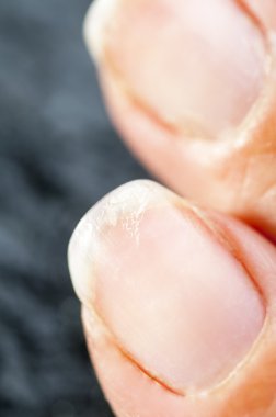 Brittle damaged fingernails clipart