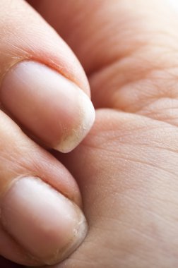 brittle damaged fingernails clipart