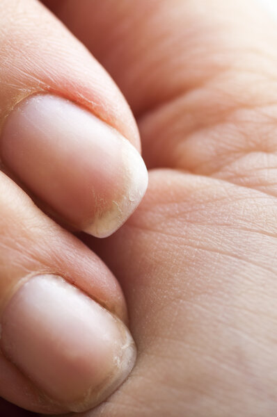 brittle damaged fingernails