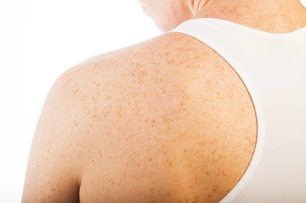 Woman's shoulder with pigmentation — Stock Photo, Image