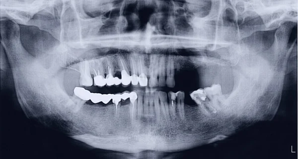 Panoramic x-ray of the mouth — Stock Photo, Image