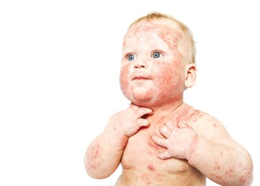 Little baby with dermatitis clipart