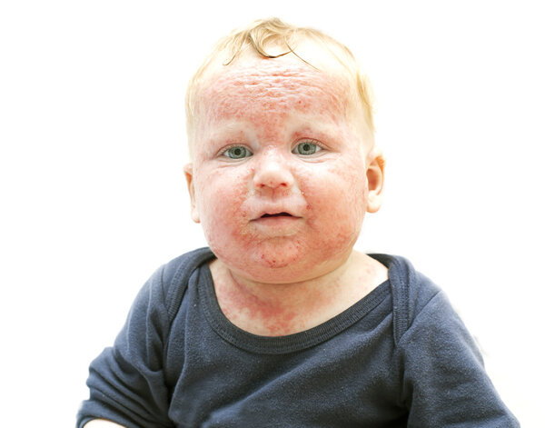 Baby boy with dermatitis