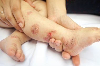 Çocuk ayak üzerinde yaralar 