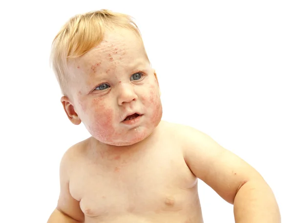 Little baby with dermatitis — Stock Photo, Image