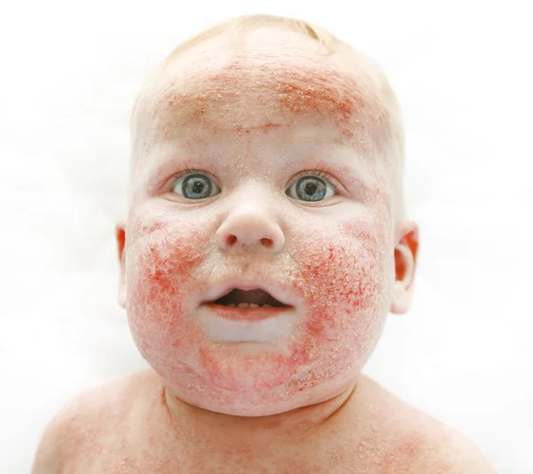 Little baby with dermatitis on face — Stock Photo, Image