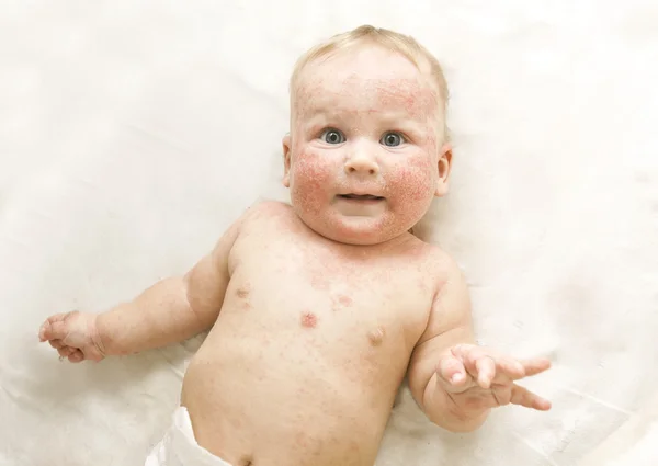 Bebé pequeño con dermatitis en la cara — Foto de Stock