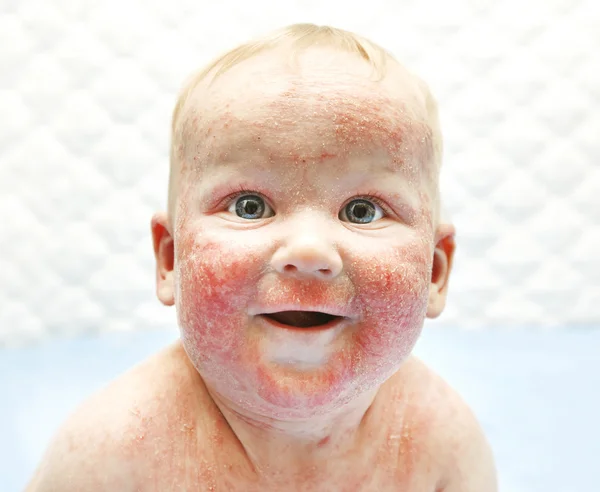 Little baby with dermatitis on face — Stock Photo, Image