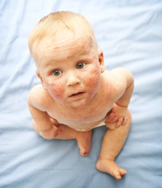 Yüzündeki dermatit ile küçük bebek