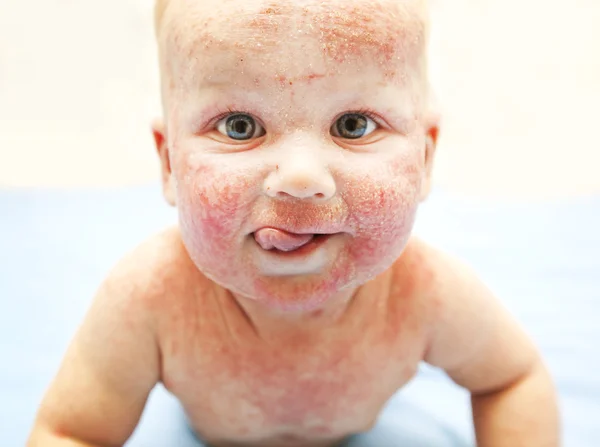 Little baby with dermatitis on face — Stock Photo, Image