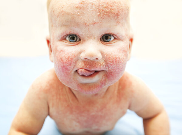 Little baby with dermatitis on face
