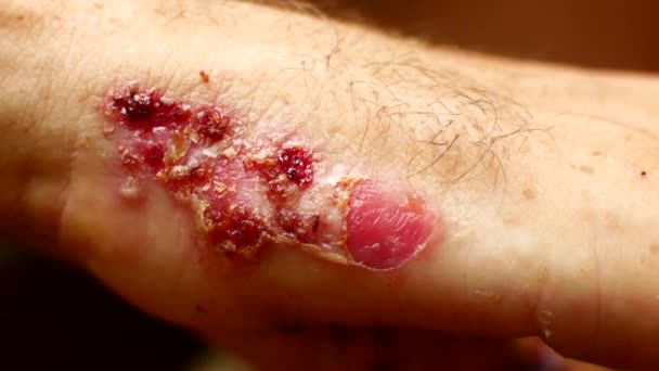 Ужасная язва на руках, болезнь — стоковое видео