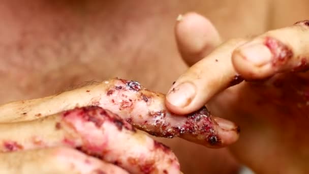 A man smears cream on his sore hands — Stock Video