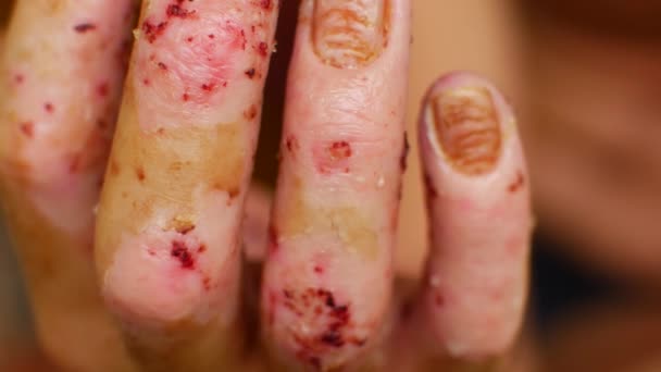 Fruktansvärda sår på händerna, sjukdom — Stockvideo