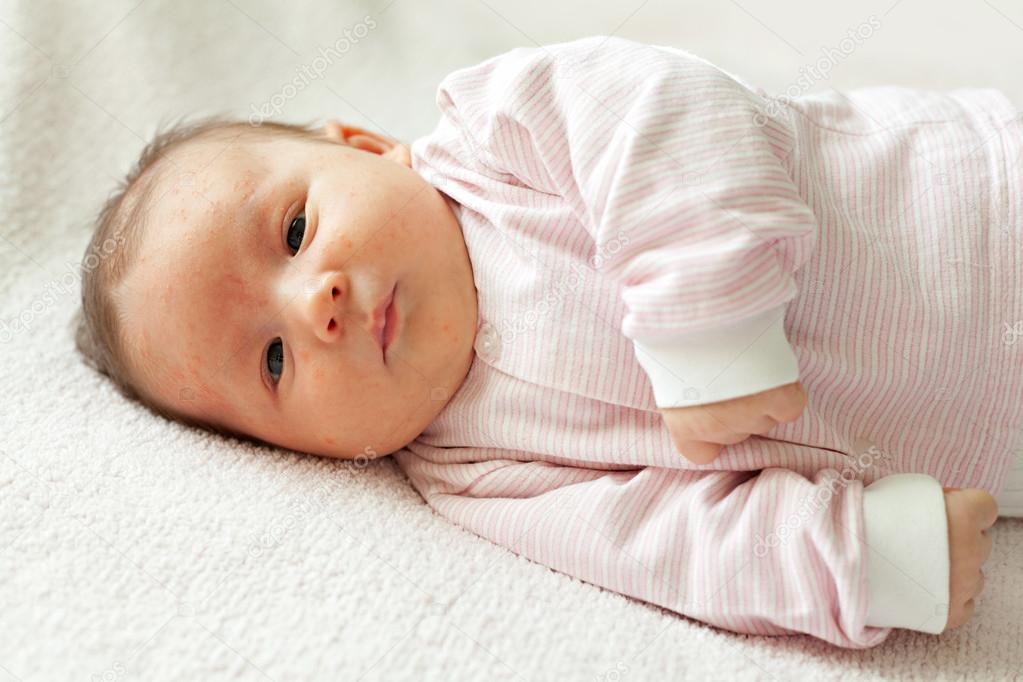 Hormonal rash of newborns
