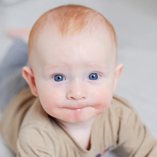 Ragazzo dai capelli rossi con dermatite — Foto Stock